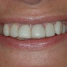 How do Veneers compare to Thineers? Which would you recommend?