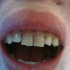 Gap between front teeth (via mobile)