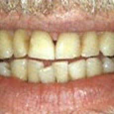 Yellow teeth…