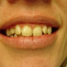 CEREC VENEERS (via mobile)