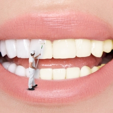 Maintenance for Resin Veneers