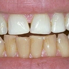 Do I need to Whiten my teeth first before I can get VENEERS?