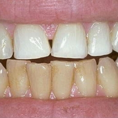 Do I need to Whiten my teeth first before I can get VENEERS?