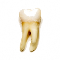 TOOTH REGENERATION GEL COULD REPLACE PAINFUL FILLINGS