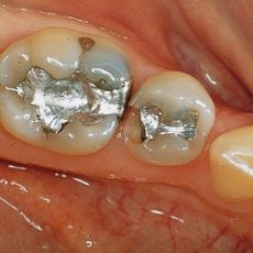 Finally, the ideal Dental Filling!