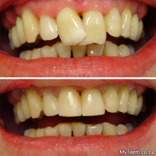 BEFORE: Heavily overlapping front teeth.  AFTER:  Cosmetic contouring and resin veneers done in 1 visit
