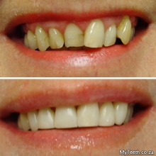 BEFORE:  Irregular teeth showing old defective white fillings.  AFTER:  Teeth reshaped and sculpted with composite fillings/veneers in just 2 hours.