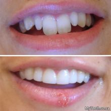 BEFORE:  Uneven front teeth with abnormal small laterals and overly long centrals. AFTER:  Gum reshaping and Dental Veneers in resin were used to shorten the centrals and build out the laterals to create a more pleasing smile.