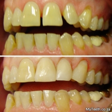 BEFORE:  Uneven gaps and alignment of teeth.  AFTER:  Gaps were closed with white fillings and composite bonding.