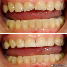BEFORE: Worn down 4 front teeth due to teeth grinding.  AFTER:  Composite Fillings done in 1 visit and a bite plate must be warn to prevent future wear.