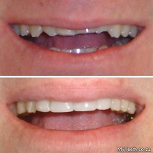BEFORE:  Worn down front teeth.  AFTER:  Dental Veneers (resin) in 1 visit to change the patient's smile.