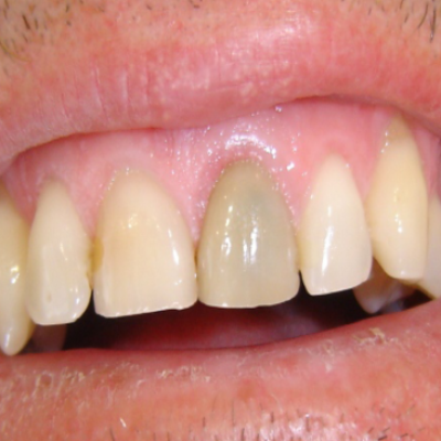 My one dark front tooth