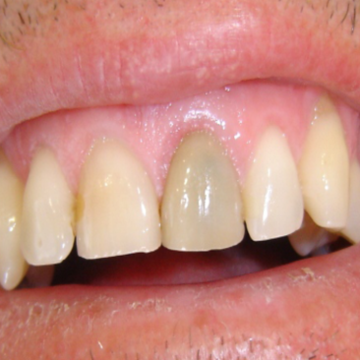 My one dark front tooth