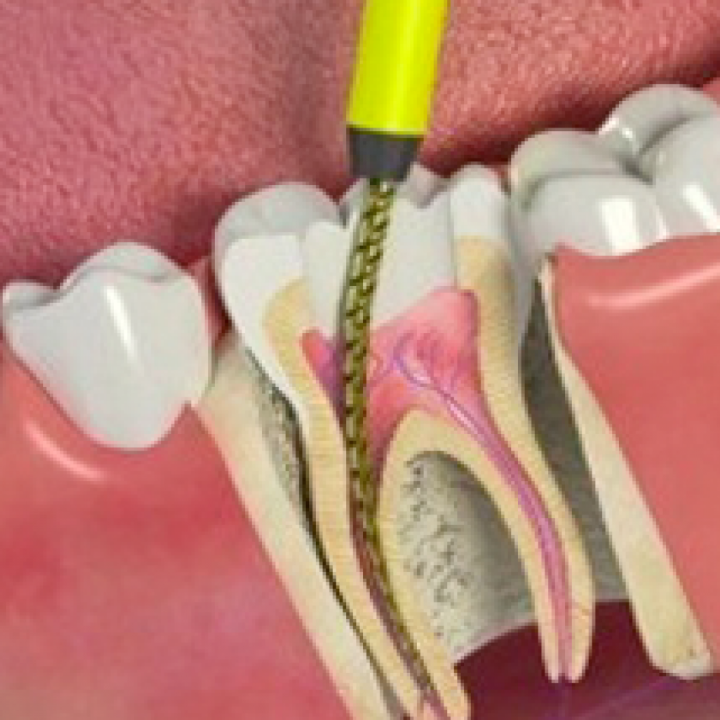 Root Canal Treatment