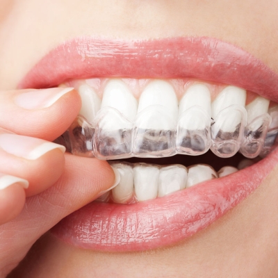 Tray Teeth Whitening