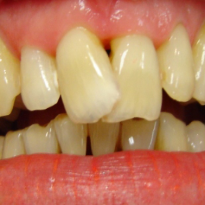 My front teeth are skew