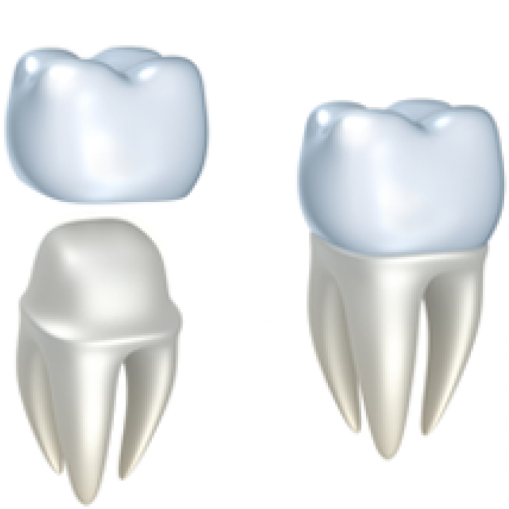 Dental Crowns