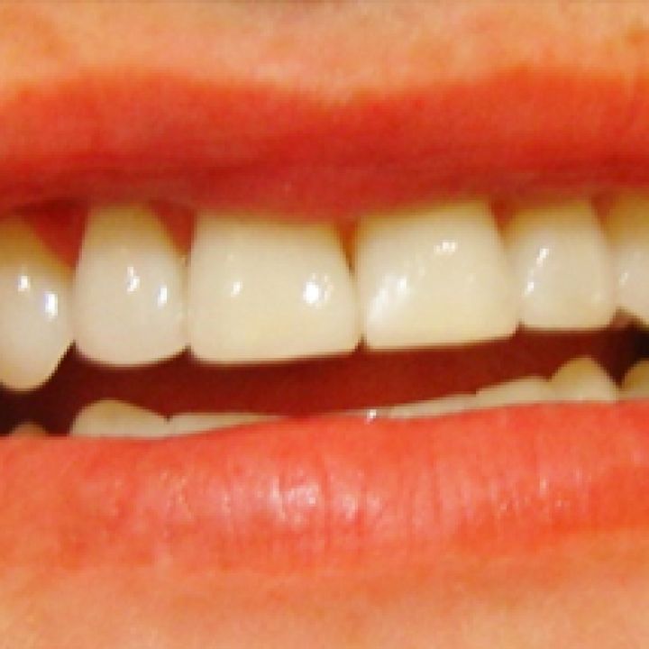 Composite Veneers