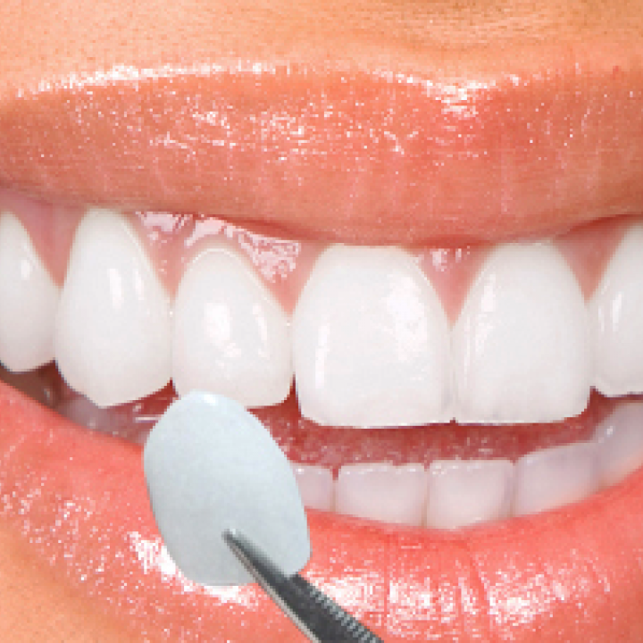 Porcelain Veneers Cape Town