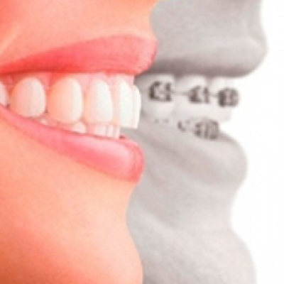 Clear Braces Consultation