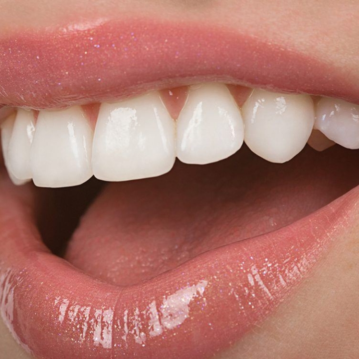 Cerec Veneers