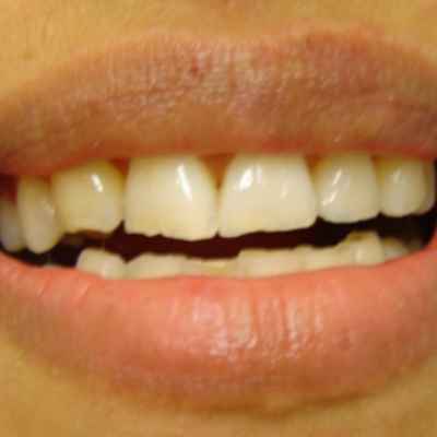 Chipped front teeth and uneven biting edges