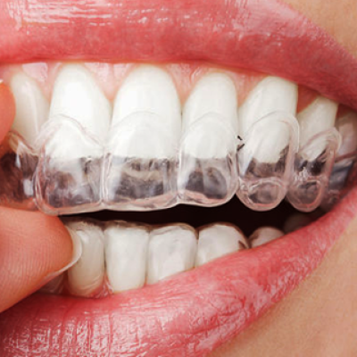 Custom Tray Teeth Whitening