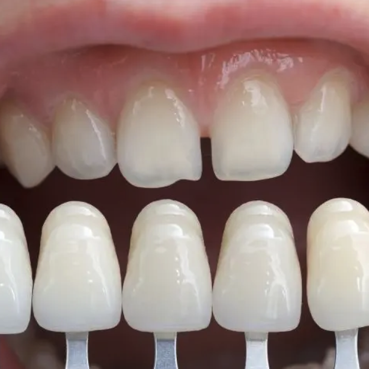 Resin Veneers Maintenance