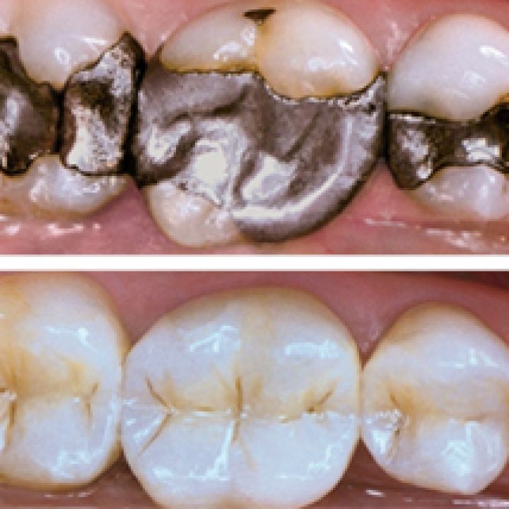 Composite Fillings