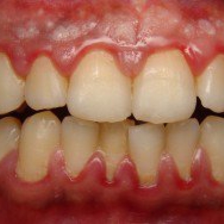 Gum Disease Treatment