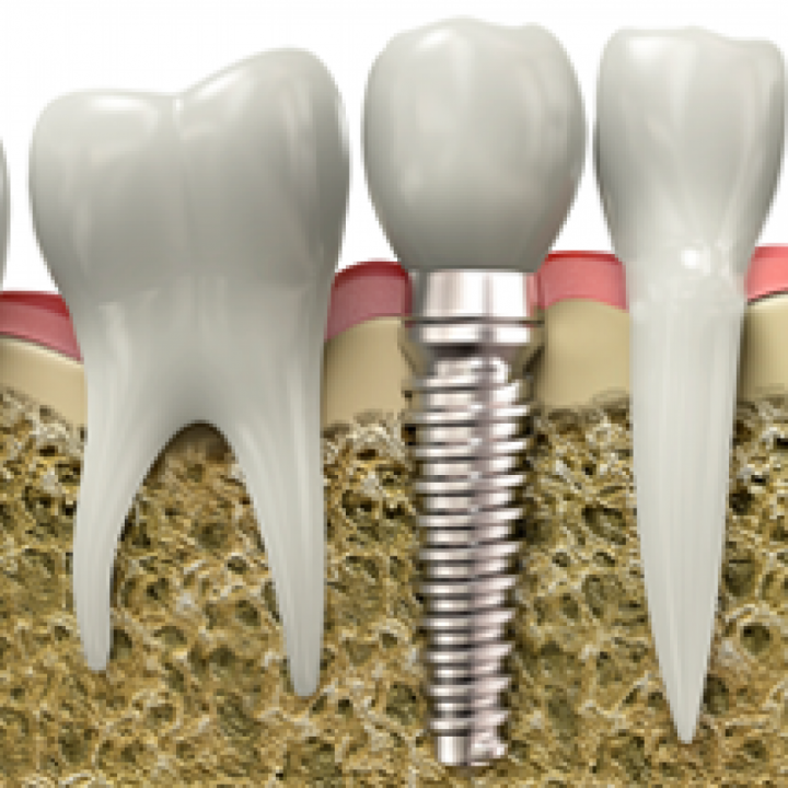 Dental Implants - Save Your Smile!