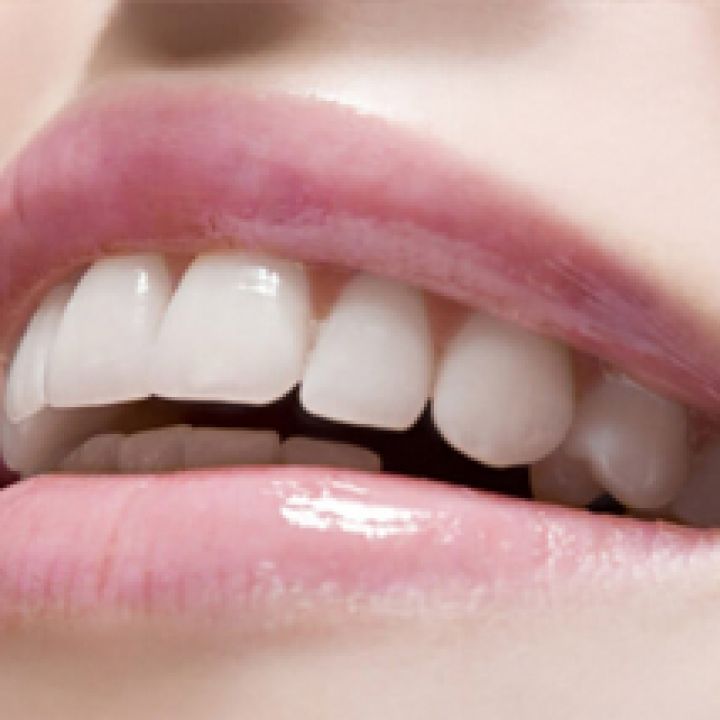 Composite Bonding, What Is It?