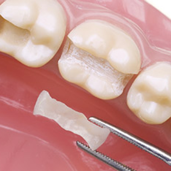 Cerec Fillings (Inlays/Onlays)