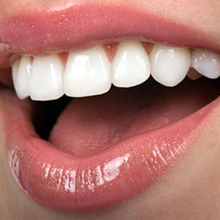 Resin Veneers Cape Town