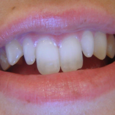 Front Teeth are Too Long or Too Short