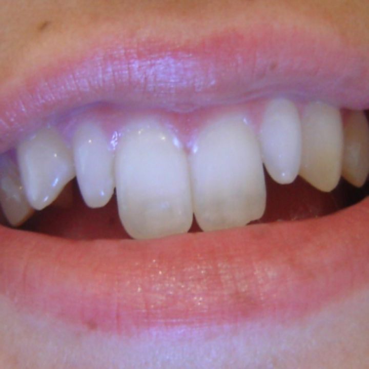 Front Teeth are Too Long or Too Short