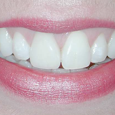 Front Teeth Too Big or Too Small