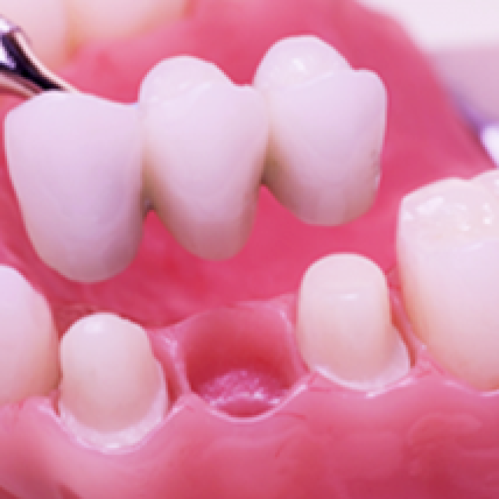 Dental Bridges