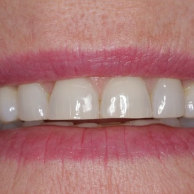 My Front Teeth Are All The Same Length