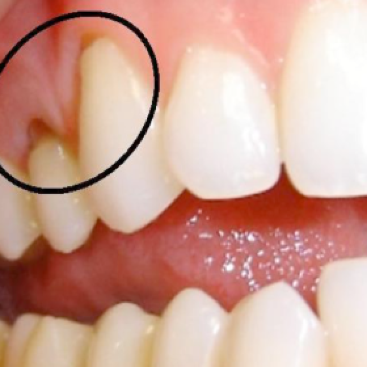 The Necks of My Teeth Have Indentations or Grooves