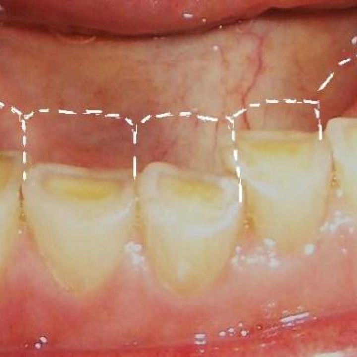 Treatment for tooth wear