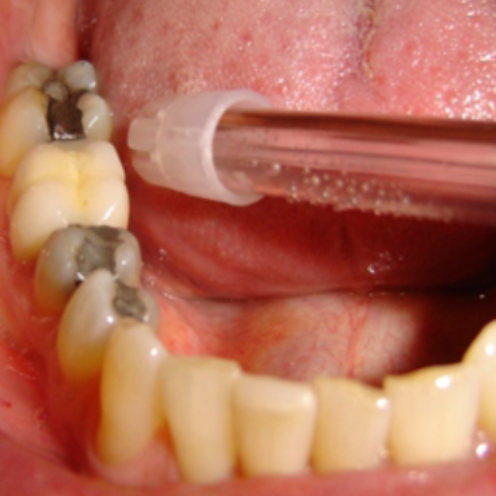 Unsightly and Defective Metal Fillings
