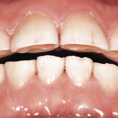 What is tooth wear?