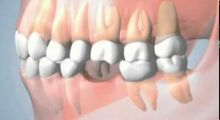 Should I replace my missing tooth?