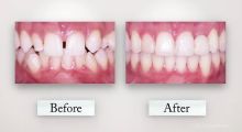Clear Aligners