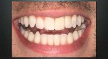 Inman Aligner